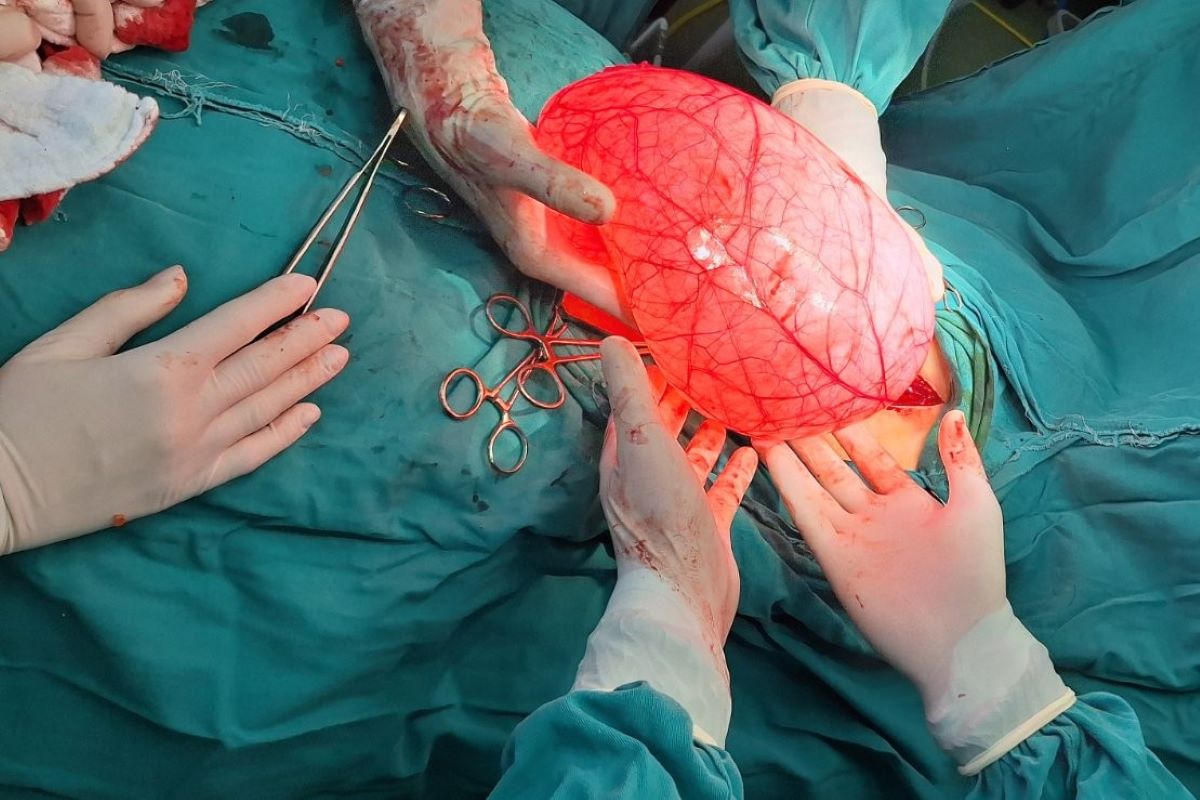 Hirurzi odstranili tumor